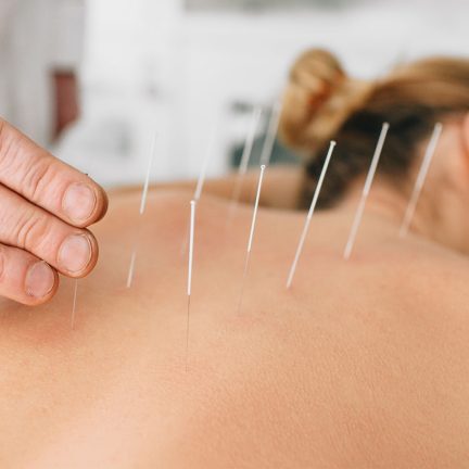 acupuncture